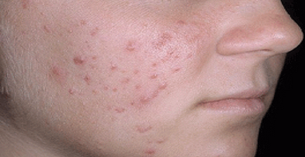 حب الشباب حب الشباب